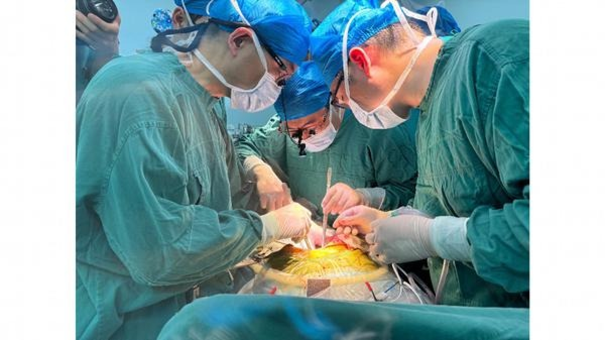 Các bác sĩ phẫu thuật ghép gan lợn chỉnh sửa gien cho bệnh nhân nam 71 tuổi vào ngày 17/5/2024. Ảnh tư liệu của Bệnh viện số 1 trực thuộc Đại học Y An Huy