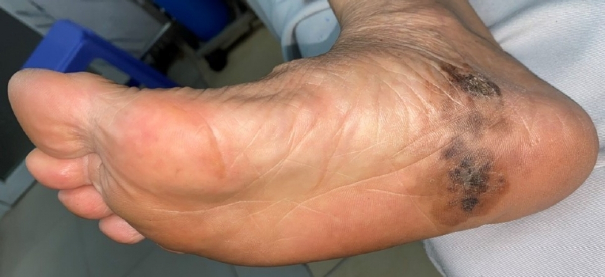 Hình ảnh bàn chân một trong những bệnh nhân mắc ung thư tế bào hắc tố