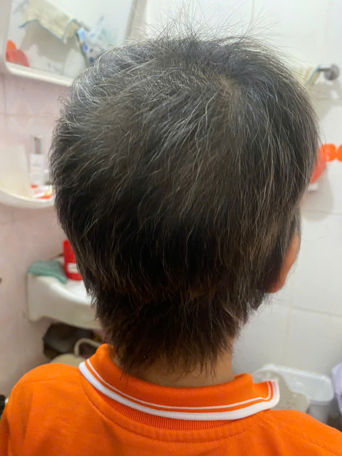 Tóc cháu bé đã mọc trở lại sau quá trình điều trị tại BV Da liễu Trung ương