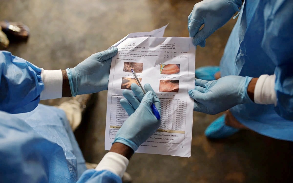 Chưa xác định được nguồn lây ca đậu mùa khỉ ở Đồng Nai. Ảnh minh họa