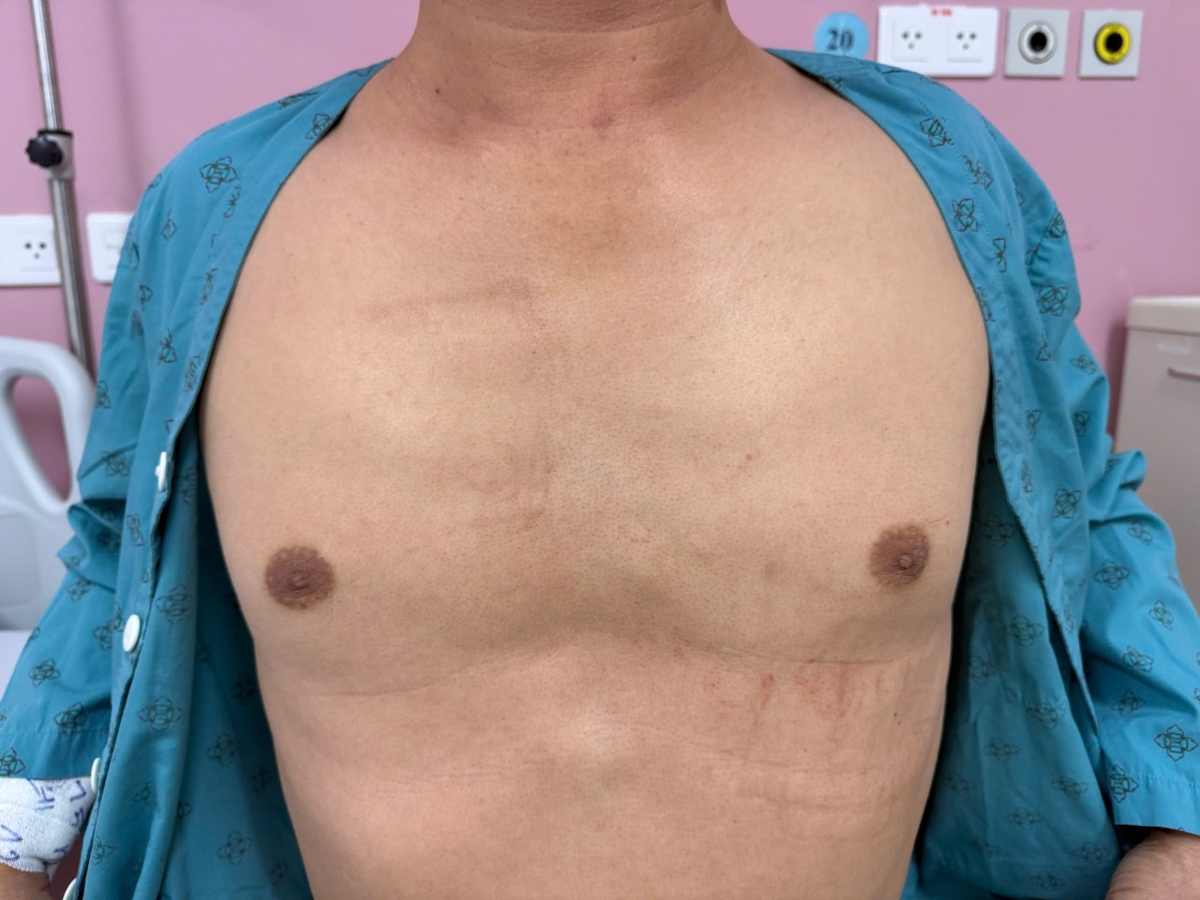 Hình ảnh các vết sẹo do sốc điện trong quá trình cấp cứu ngừng tuần hoàn.