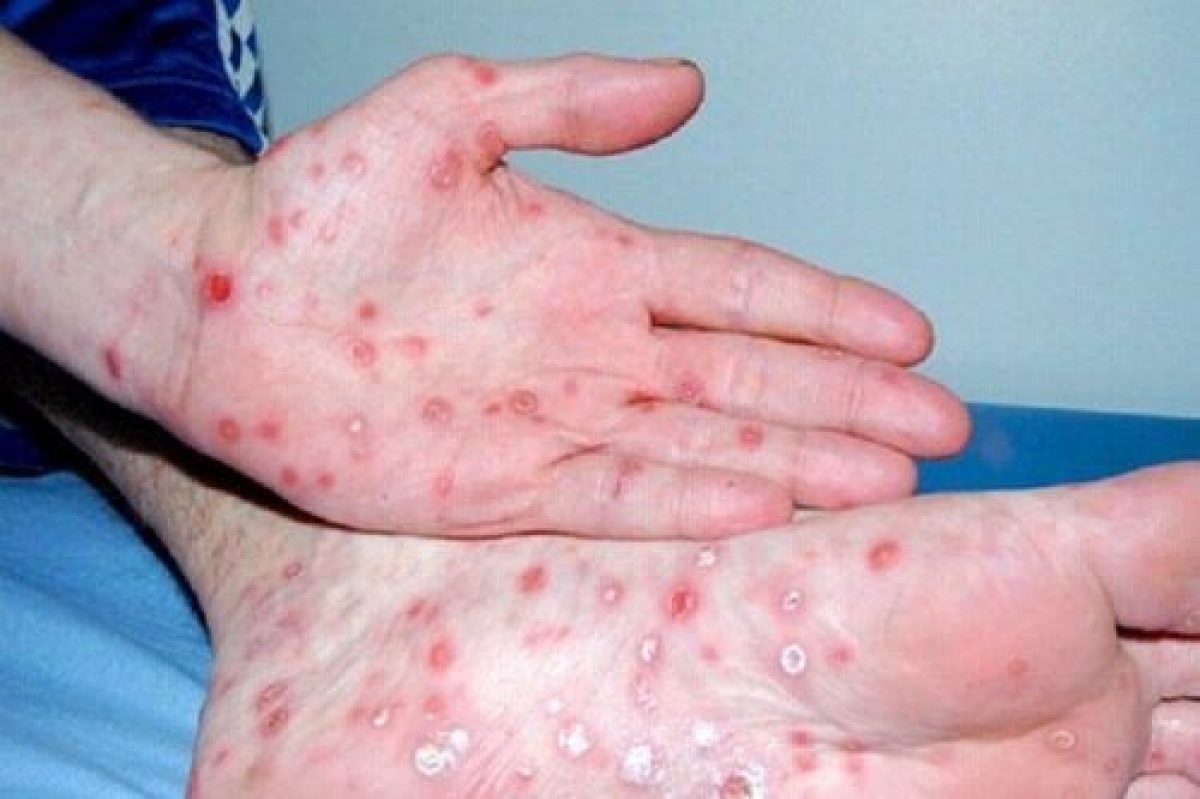 Người mắc bệnh giang mai từ giai đoạn 2 thường xuất hiện các vết xăng giang mai ở tay, chân, lưng, ngực, bụng....