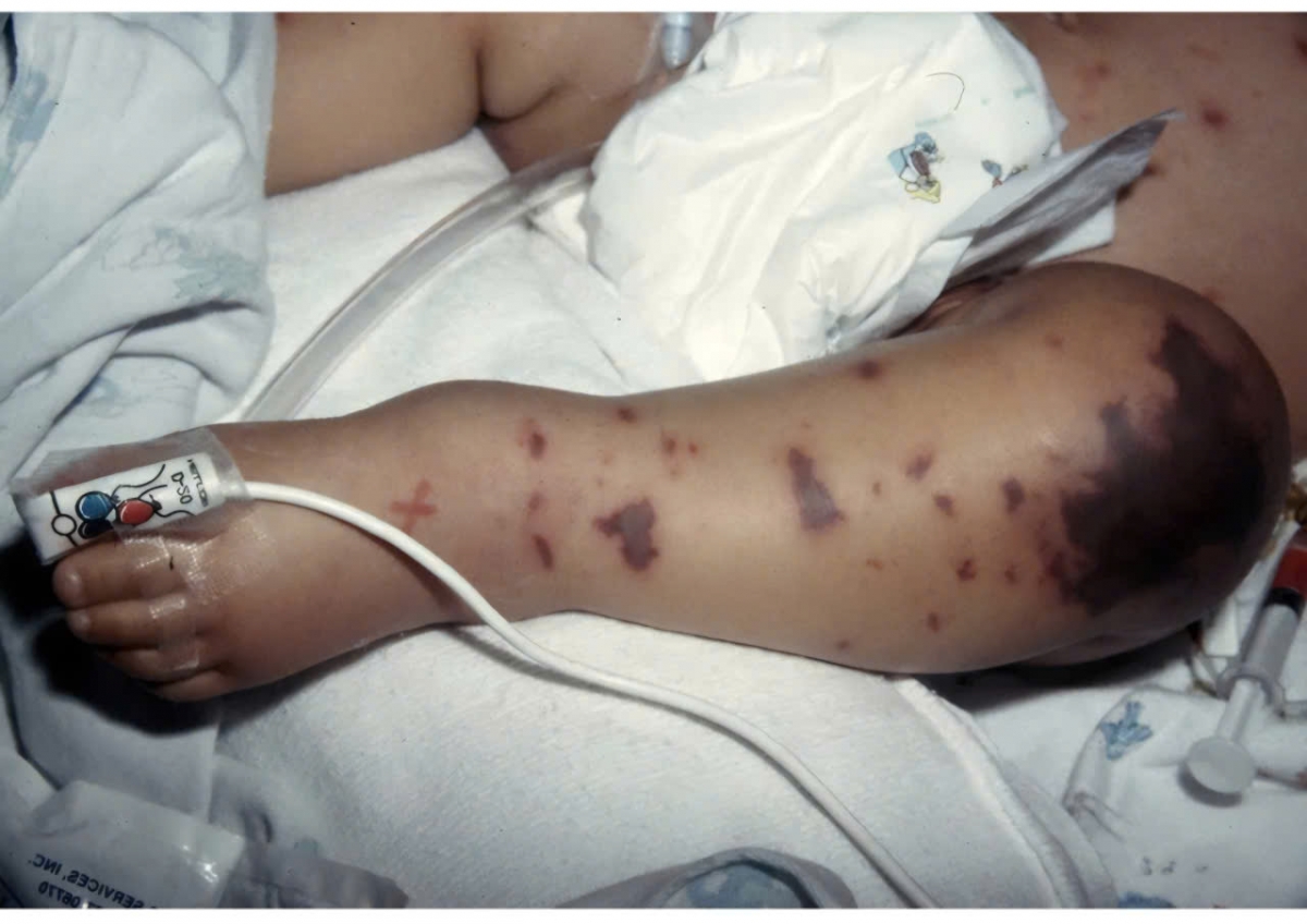 Dấu hiệu tử ban trên da của bệnh nhi mắc não mô cầu.