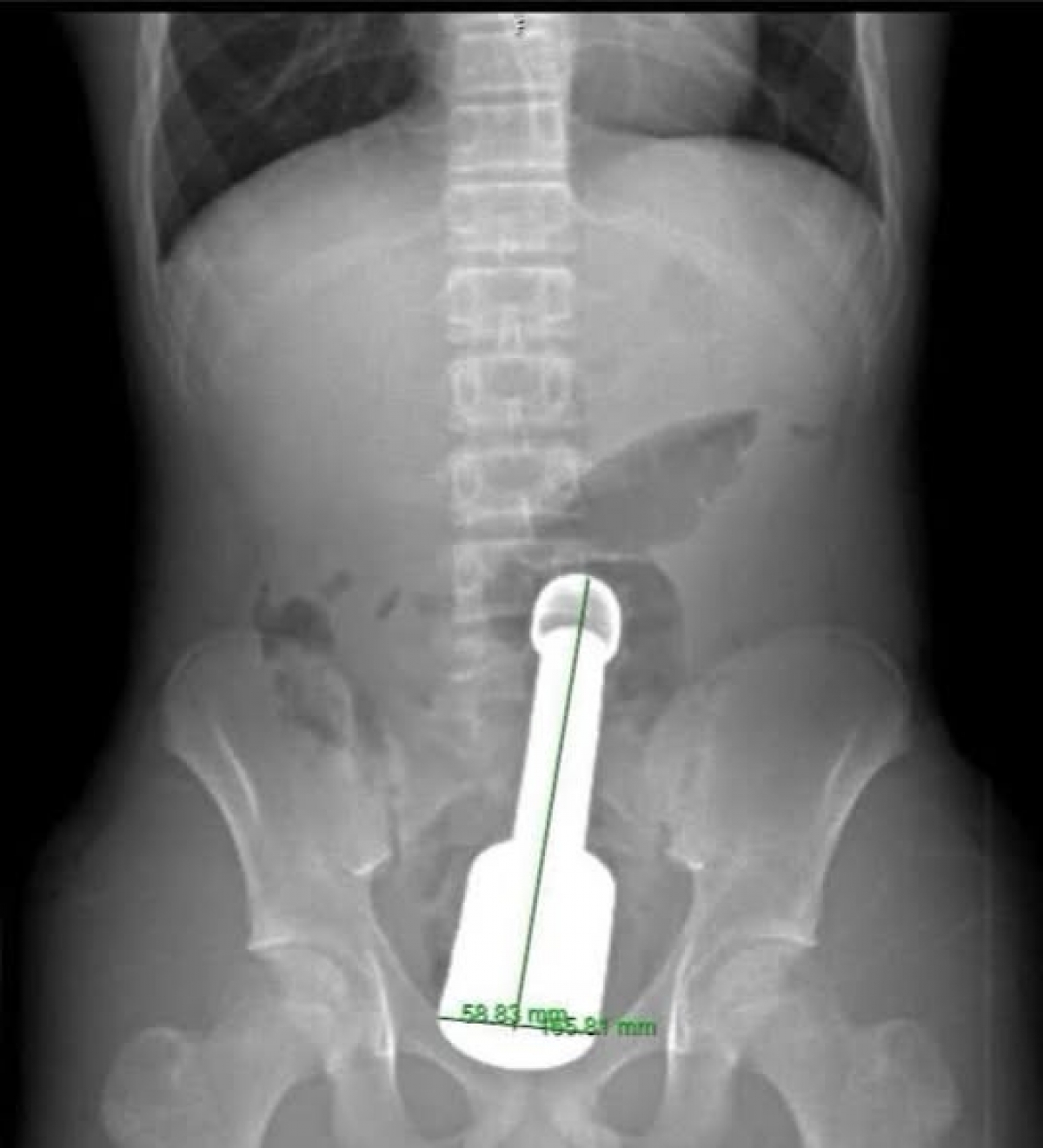 Hình ảnh phim chụp X. quang dị vật trong trực tràng bệnh nhân