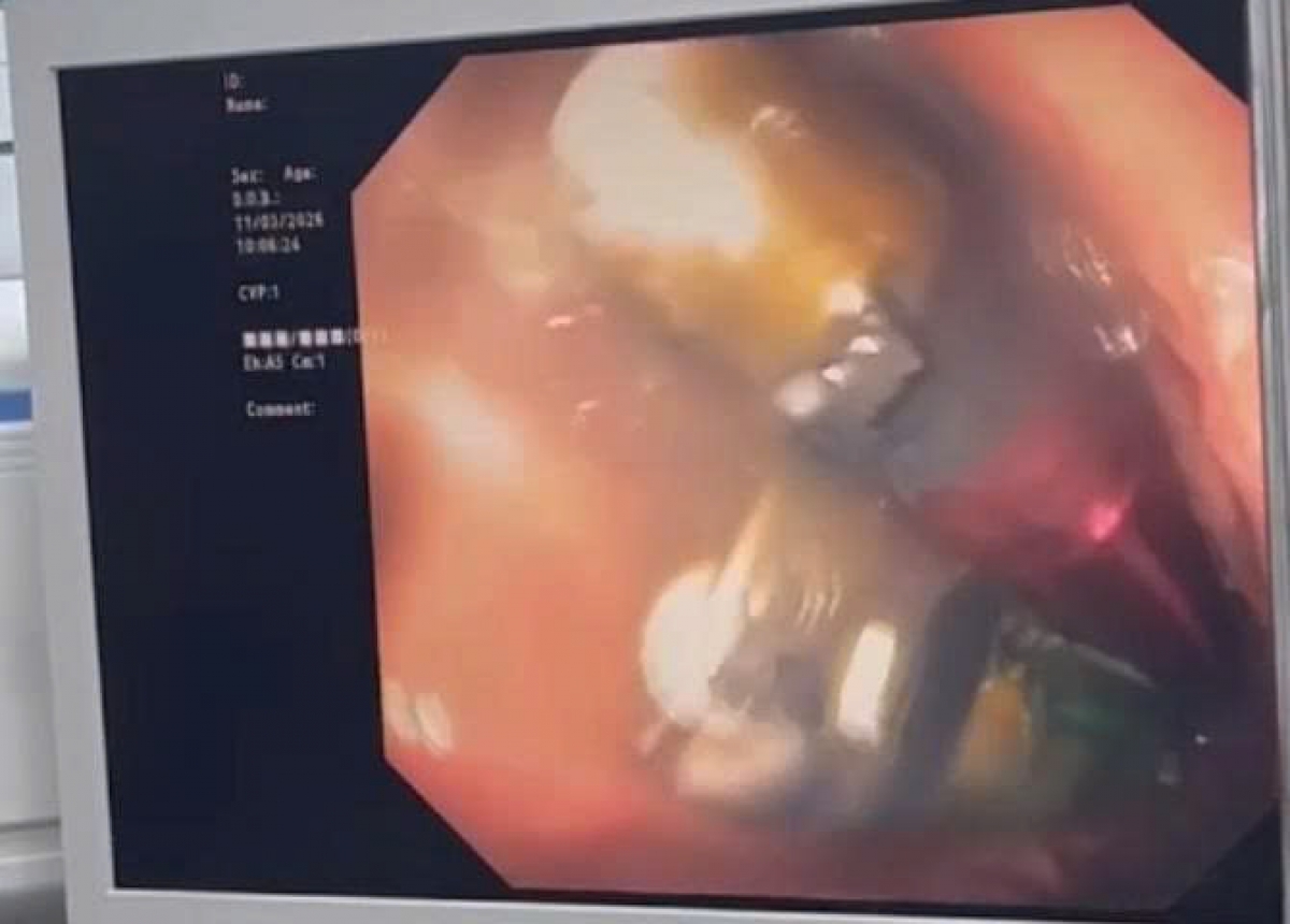 Hình ảnh bật lửa trong dạ dạy người bệnh