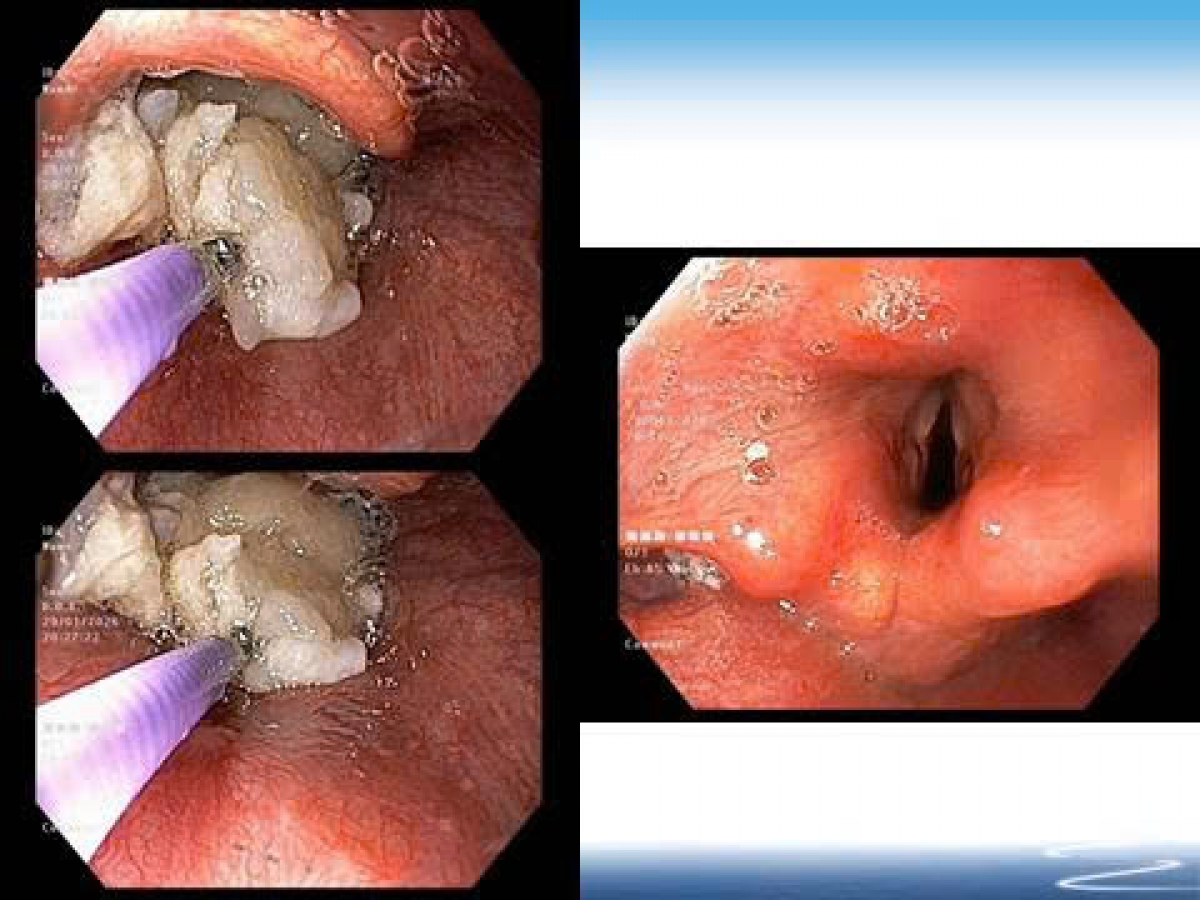 Hình ảnh nội soi phát hiện dị vật là miếng thịt lớn trong hầu họng của người bệnh