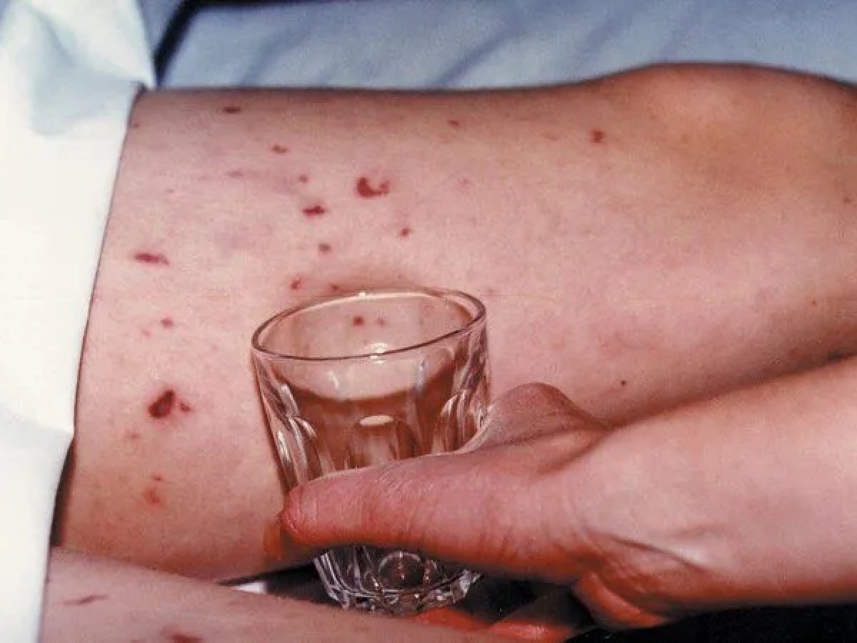 Tử ban do não mô cầu có đặc trưng là không biến mất khi dùng một vật trong suốt như ly thủy tinh ấn lên da.