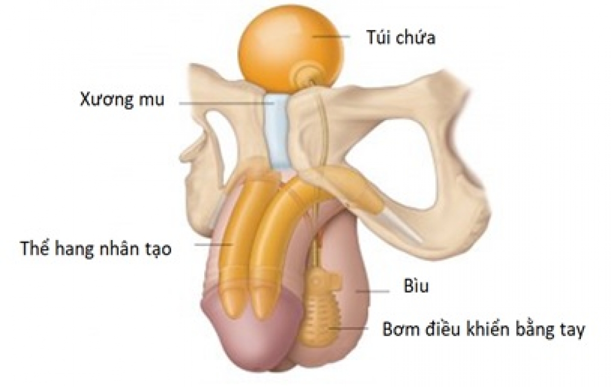 Thể hang nhân tạo 3 mảnh (Ảnh minh họa)