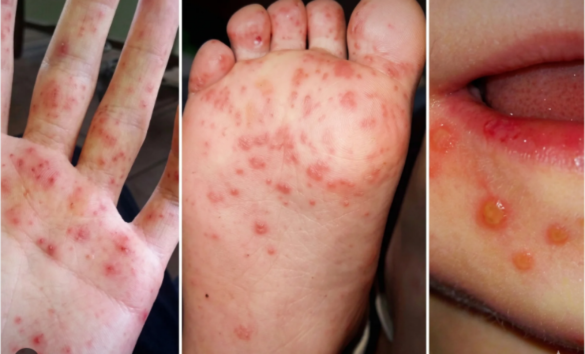 Biểu hiện của bệnh tay chân miệng ở trẻ em. Ảnh minh hoạ