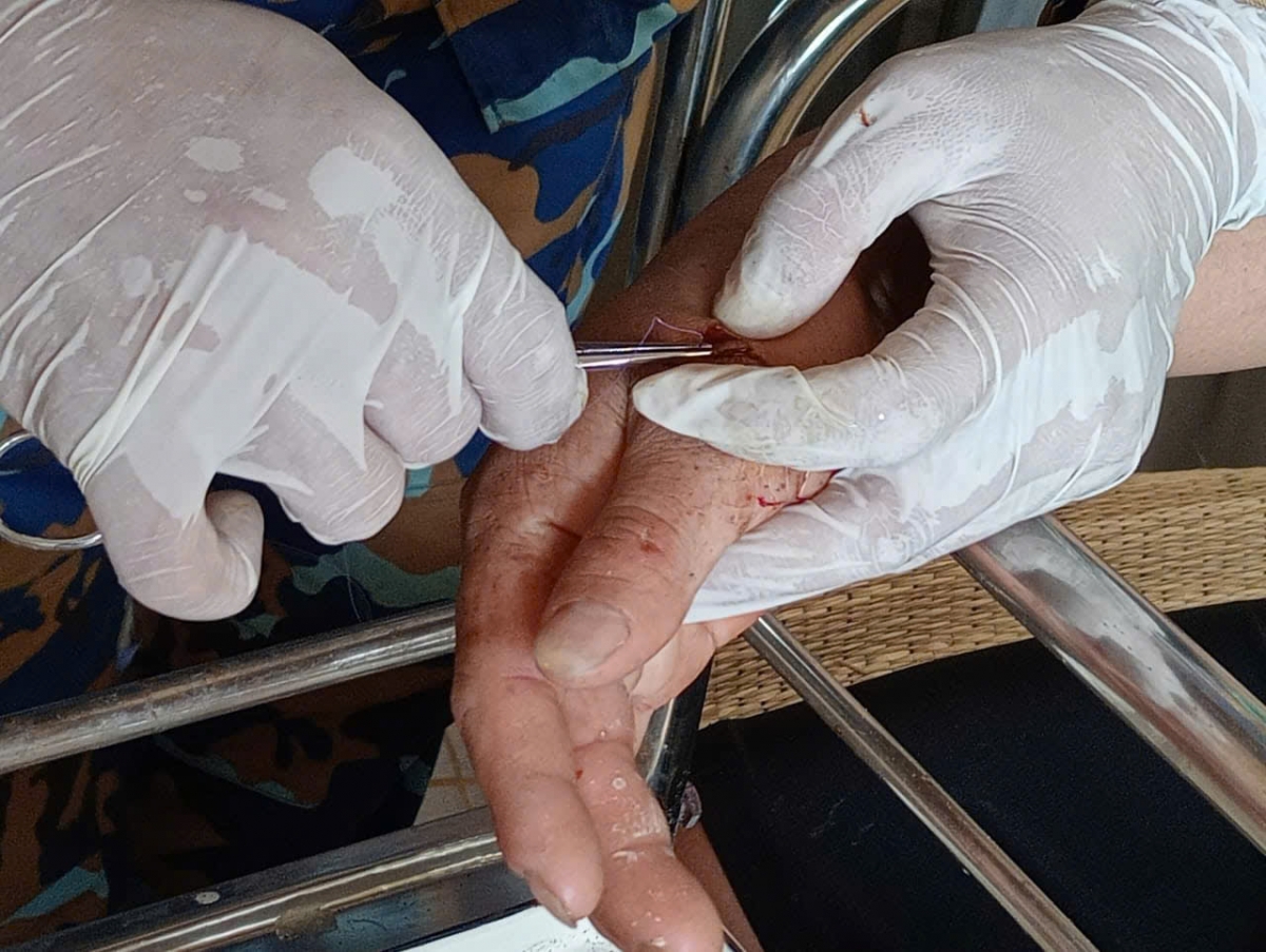 Tiến hành khâu vết thương cho ngư dân