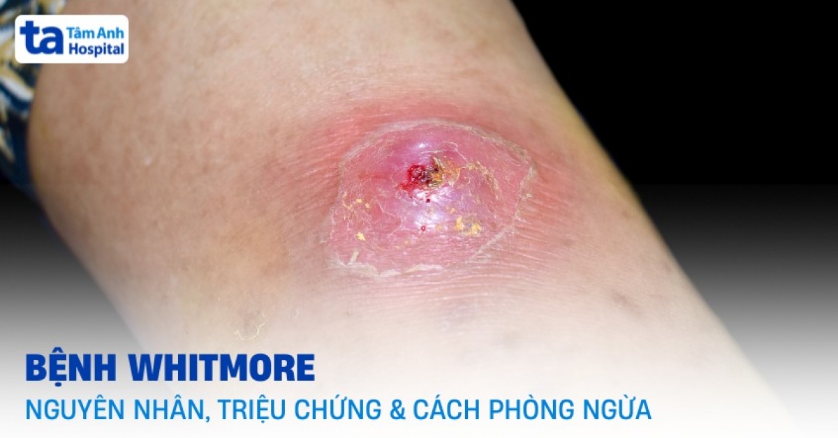 Tại Việt Nam, hằng năm vẫn ghi nhận một số ca bệnh Whitmore rải rác