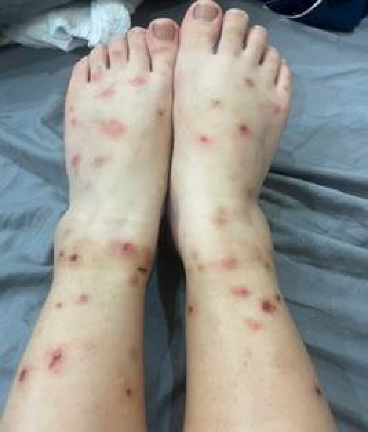 Hình ảnh bệnh nhân bị bọ chét đốt gây sẩn ngứa da