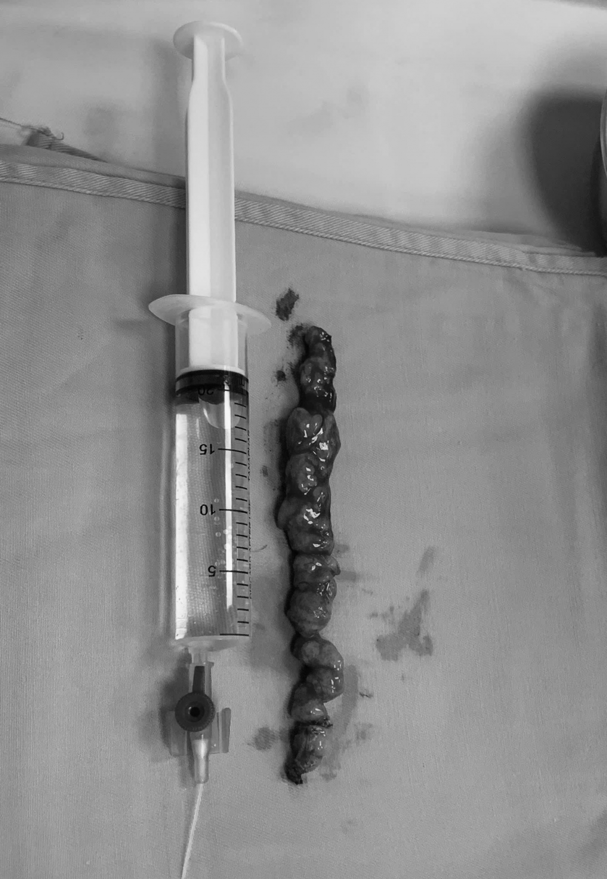 U tủy cột sống đã được phẫu thuật khỏi cơ thể người bệnh