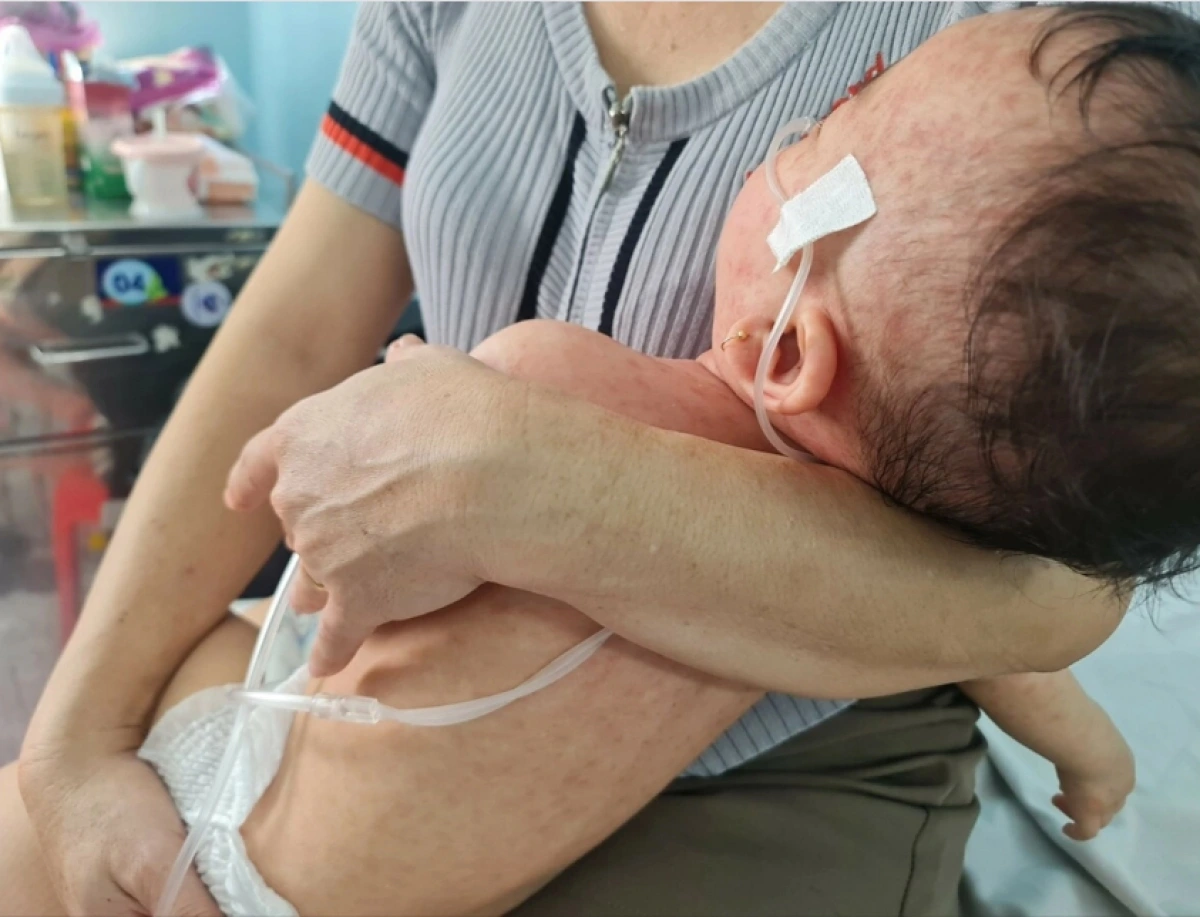 Nhiều trẻ phải thở máy do bệnh Sởi gây biến chứng viêm phổi