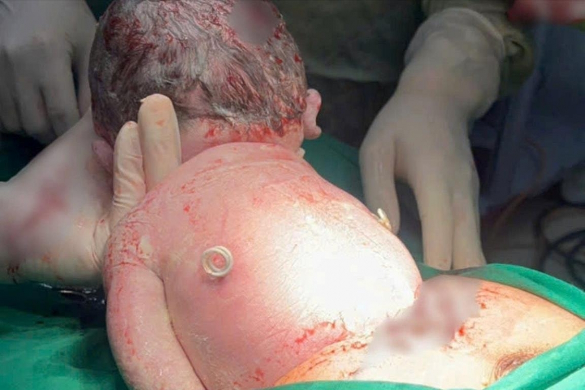 Một trường hợp trẻ chào đời bình an với hai ống shunt dẫn lưu trên lưng sau ca can thiệp bào thai thành công.