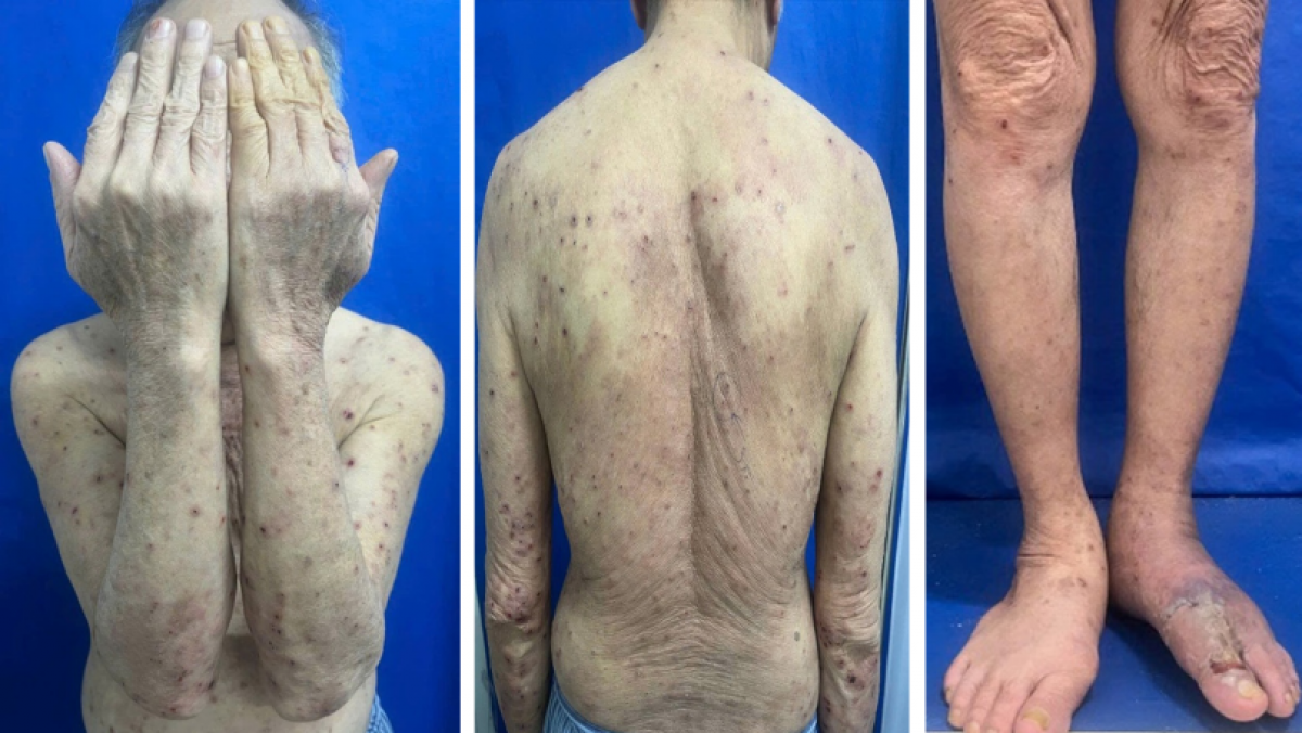 Bệnh nhân nam bị sẩn ngứa khắp cơ thể khi đến khám và điều trị tại BV Da liễu Trung ương