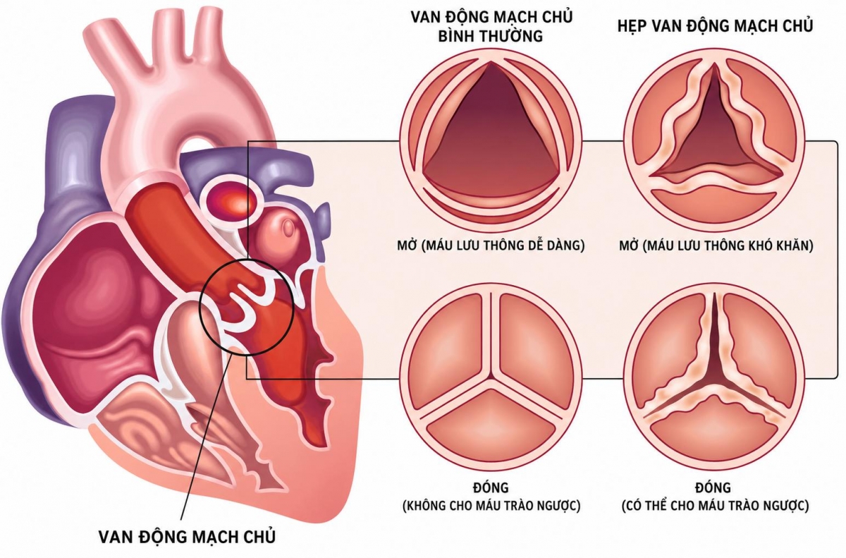 Hình ảnh giải phẫu van động mạch chủ.