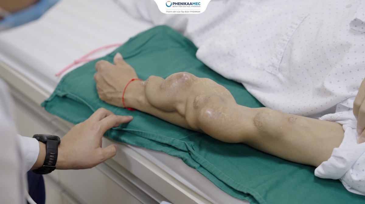 Cánh tay trái của người bệnh xuất hiện nhiều khối phình lớn nối tiếp nhau sau 11 năm duy trì lọc máu qua cầu nối động - tĩnh mạch (AVF).