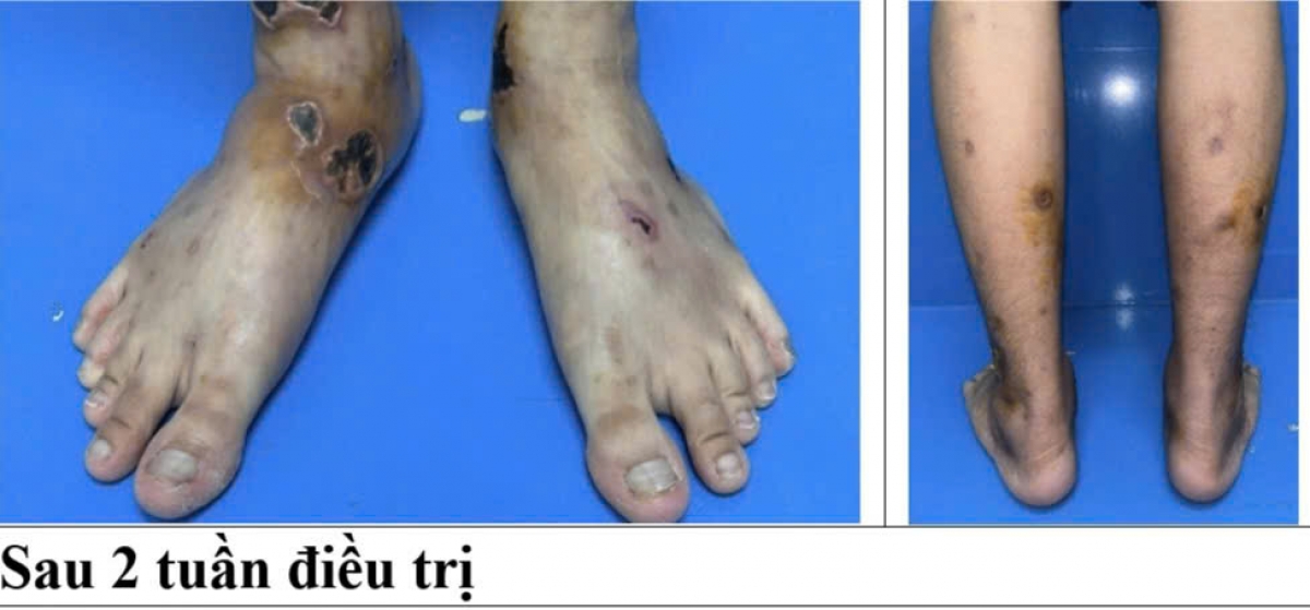 Hình ảnh bệnh nhân trước và sau 2 tuần điều trị 