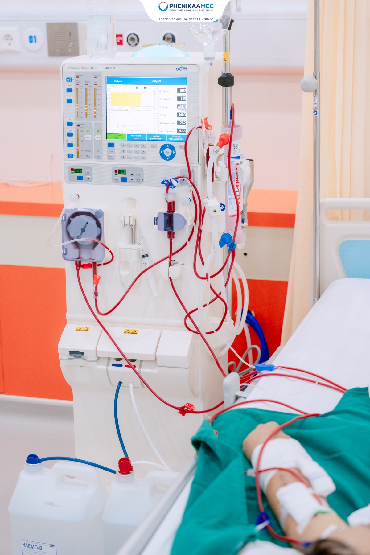 Người bệnh được lọc máu an toàn ngay sau can thiệp trên chính cầu nối AVF đã được bảo tồn.