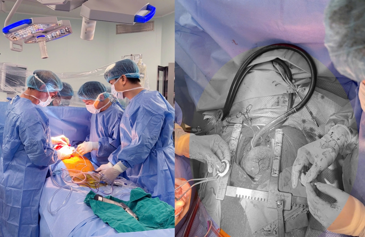 Hình ảnh cuộc phẫu thuật cấy ghép CorHeart 6 đầu tiên tại Bệnh viện Trung ương Quân đội 108
