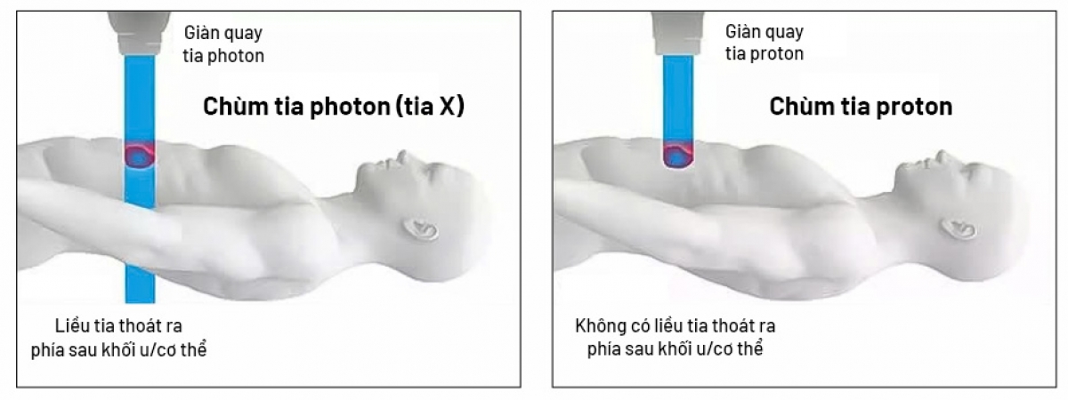 Xạ trị photon (tia X) đưa liều xạ vào khối u nhưng vẫn “đi xuyên qua” cơ thể gây tổn thương mô lành; còn xạ trị proton với tia năng lượng biết “dừng đúng chỗ” để tiêu diệt khối u an toàn. 